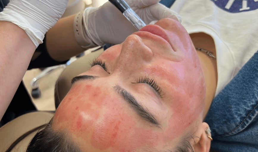 FACIAL TREATMENT